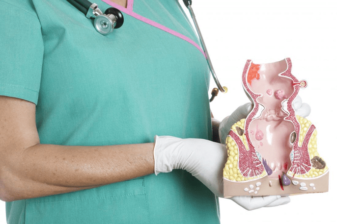 Il medico dimostra il modello emorroide