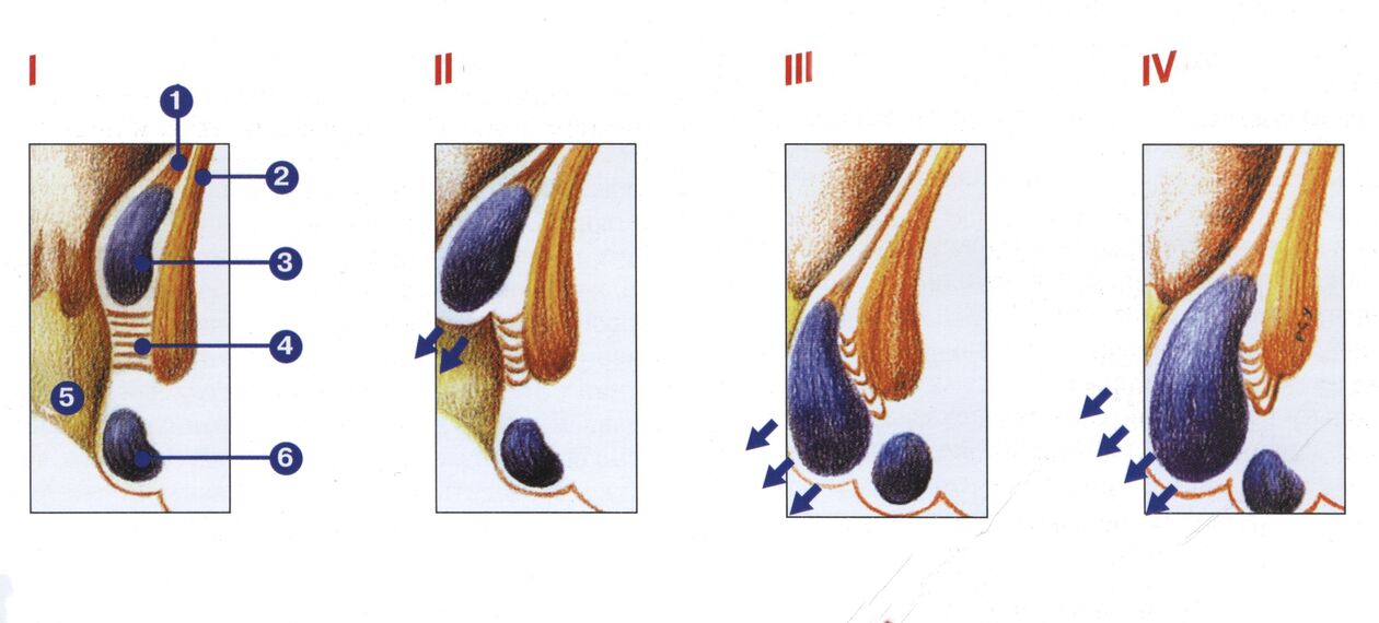 Fasi dello sviluppo delle emorroidi