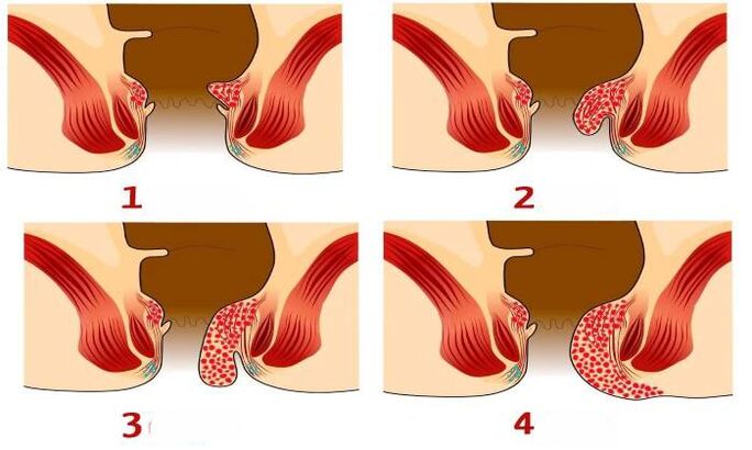 come appaiono le emorroidi nelle diverse fasi